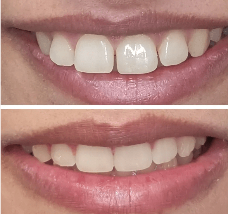 Clear aligners Before & After Our Patients Speak For Us Eon Aligner